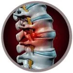 disc-issues-spine